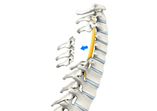 Cervical Laminectomy