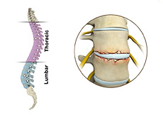 Fracture of the Thoracic Spine