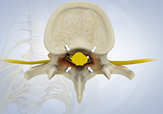 Spinal Stenosis - Cervical
