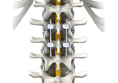 Thoracic Spinal Fusion