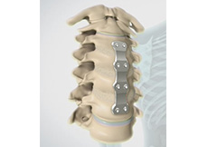 Anterior Cervical Corpectomy and Fusion