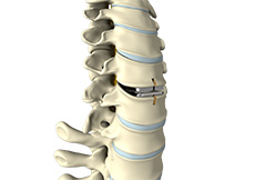Artificial Cervical Disc Replacement