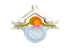 Cervical Disc Protrusion