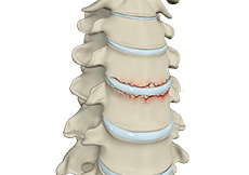 Cervical Fracture