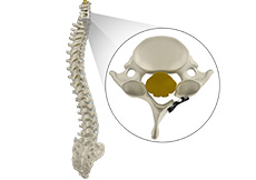 Cervical Laminoplasty