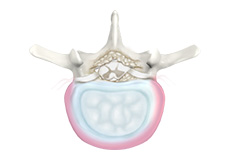 Degenerative Disc Disease (DDD)