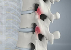 Facet Joint Arthritis