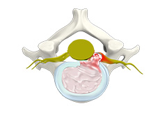 Herniated Disc (Cervical)