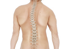 Kyphosis