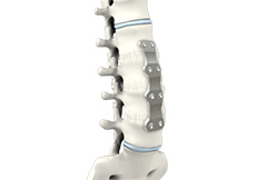 Anterior Lumbar Corpectomy and Fusion