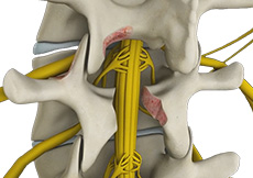 Posterior fusion for trauma