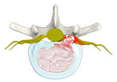 Lumbar Disc Herniation