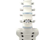 Lumbar Disc Replacement