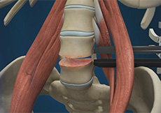 Lumbar Discectomy