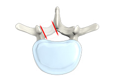 Lumbar Foraminotomy, Facetectomy