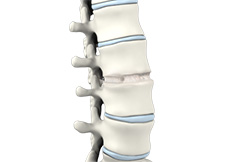 Lumbar Interbody Fusion