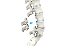 Lumbar Laminectomy (Minimally-Invasive)