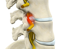 Lumbar Radiculopathy