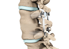 Minimally Invasive Posterior Fusion