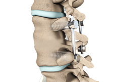 Posterior fusion for trauma