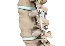 Posterior Lumbar Interbody Fusion