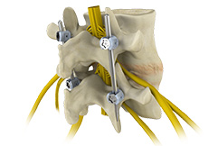 Spinal Fusion