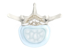 Spinal Stenosis- Lumbar