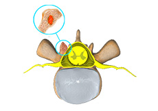 Spine Tumor Surgery