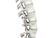 Transforaminal Lumbar Interbody Fusion